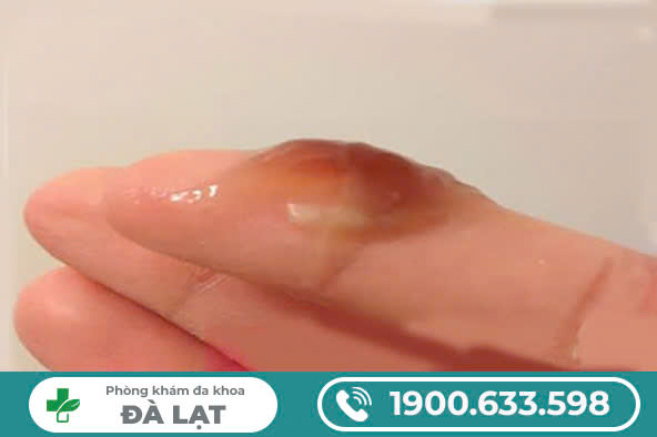 MẸ BẦU RA KHÍ HƯ MÀU NÂU? PHƯƠNG PHÁP ĐIỀU TRỊ HIỆU QUẢ NHẤT!